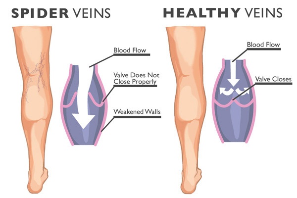 Laser Spider Veins Treatment in Doylestown, PA - Varicose Veins