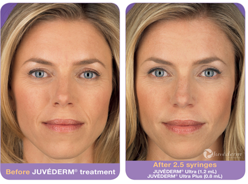 juvederm ultra doylestown