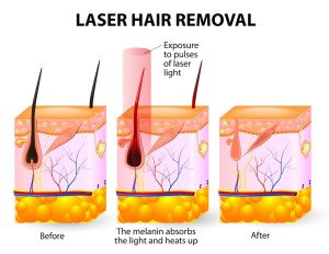 best hair removal