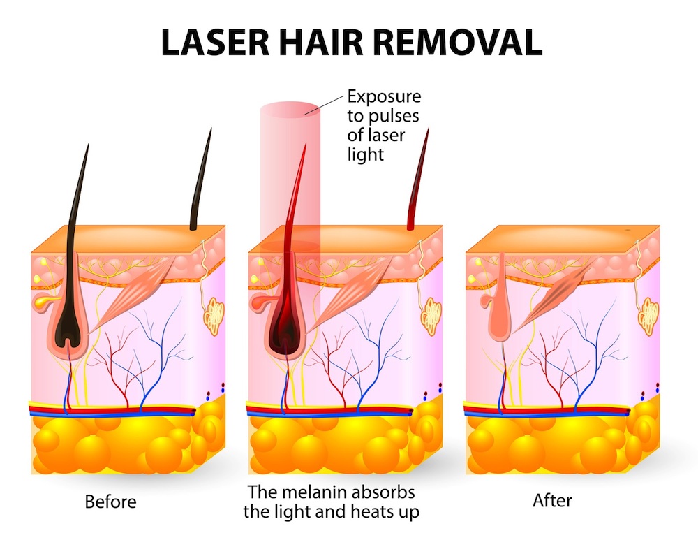 Clearfield Laser Hair Removal 