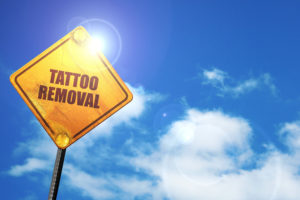 laser tattoo removal