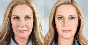 sculptra cosmetic injectables