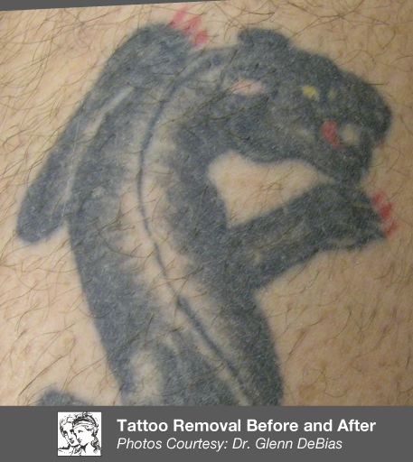 tattoo removal before and after