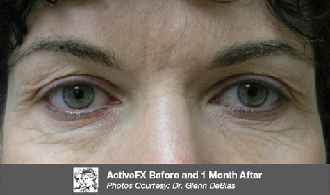 ActiveFX Before and After Photos