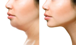 kybella double chin removal before and after